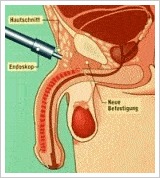 Operationstechnik Penisverlängerung